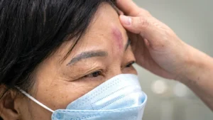 Tiêm filler sai có thể mù mắt vĩnh viễn sau vài phút